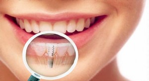  Имплантация зубов: преимущества и процедура