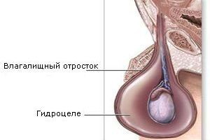  Что такое отек или водянка яичек?