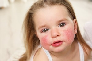  Лечение поноса, устранение симптомов пищевой аллергии у ребенка