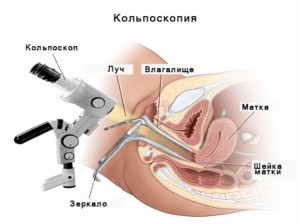  Кольпоскопия – показания. Как подготовиться к процедуре?