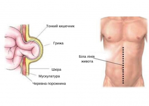  Описание и особенности грыжи