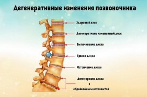  Дегенерация позвоночника   симптомы, лечение