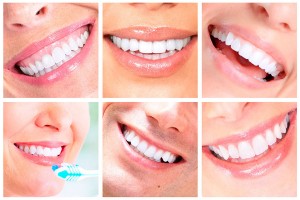  Отбеливание зубов: особенности, типы