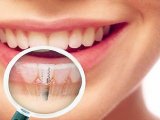 Имплантация зубов: преимущества и процедура