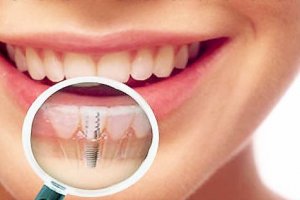 Имплантация зубов: преимущества и процедура