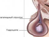 Что такое отек или водянка яичек?