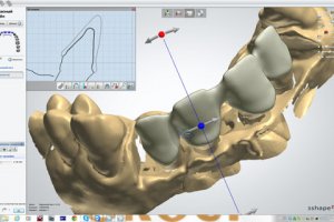 Преимущества использования CAD/CAM систем в стоматологии