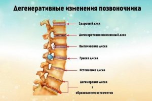 Дегенерация позвоночника - симптомы, лечение