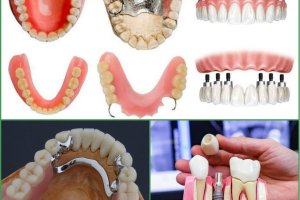 Протезирование передних зубов