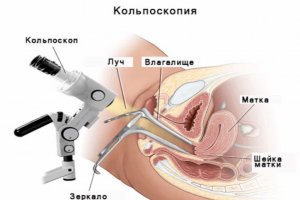 Кольпоскопия – показания. Как подготовиться к процедуре?