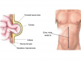 Описание и особенности грыжи
