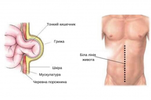 Описание и особенности грыжи